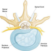 Herniated Disk